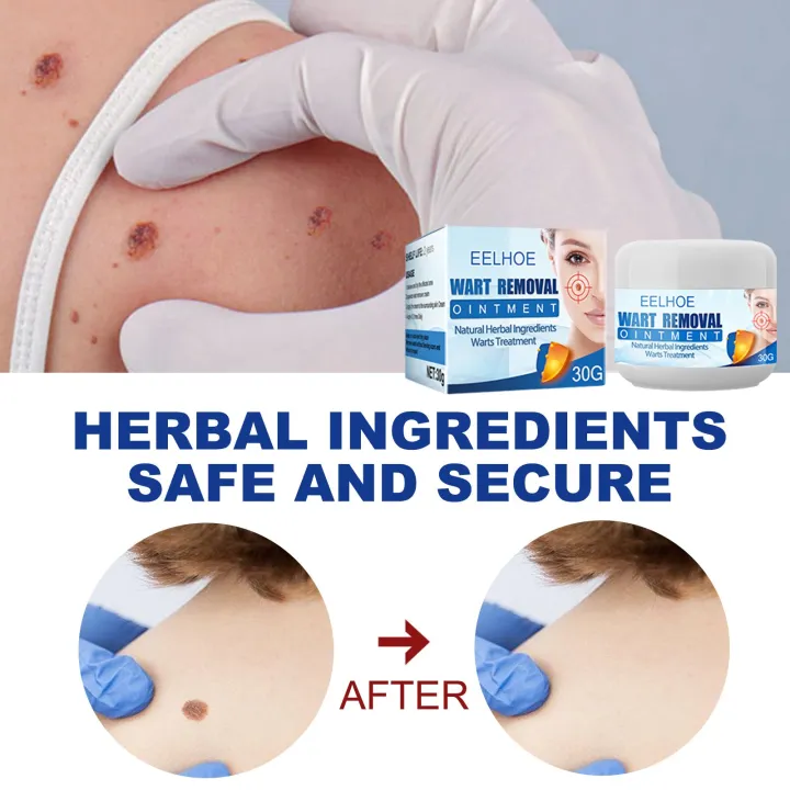 Eelhoe%20Skin%20Tag%20Remover%20Warts%20&%20Mole%20Remover%20Cream%20Remove%20Skin%20Tag%20Wart%20Callus%20Natural%20Ingredients%20Scar-Free%20Wart%20Ointment%2030G%20-%20Image%203