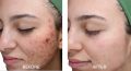 SALICYLIC  peel 15% beta hydroxy acid BHA   for acne, openpores , oilyskin , glow , exfoliation , peeling solution ,. 