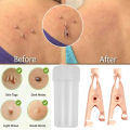 Small Clip Copper Tag Remover Skin Care Wart Remover Micro Strip Cleaning Skin Tag Removal Kit Facial Beauty Makeup Tools 1/2pcs. 