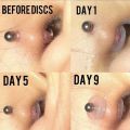 Piercing for Nose Ear Cartilage Discs with Round Ring Anti-sagging Piercing Healing Silicone Discs Fixed Rings Anti Hyperplasia. 