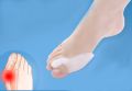 Pack Of 5 Pairs Silicone Gel Foot Fingers Hole Bunion Toe Separator Thumb Valgus Protectors. 