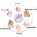1 Pair Silicone Gel Bunion Protector Toe Straightener Separator Alignment Pain Relief Thumb Corrector Orthotics Feet Care. 
