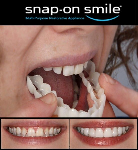 Perfect%20Smile%20Snap-On%20Veneers%20%E2%80%93%20Realistic%20Silicone%20Denture%20Covers%20for%20Upper%20&%20Lower%20Teeth%20-%20Image%205