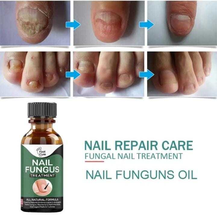 Fast%20Nail%20Fungal%20Treatments%20Nail%20Repair%20Essences%20Serum%20Care%20Treatments%20Foot%20Nail%20Fungus%20Removal%20Gel%20Paronychia%20Onychomycosis%20-%20Image%205
