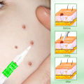Natural Ingredients Skin Tag Remover Can Effectively Remove Spots And Moles/Suitable For All Skin Types. 
