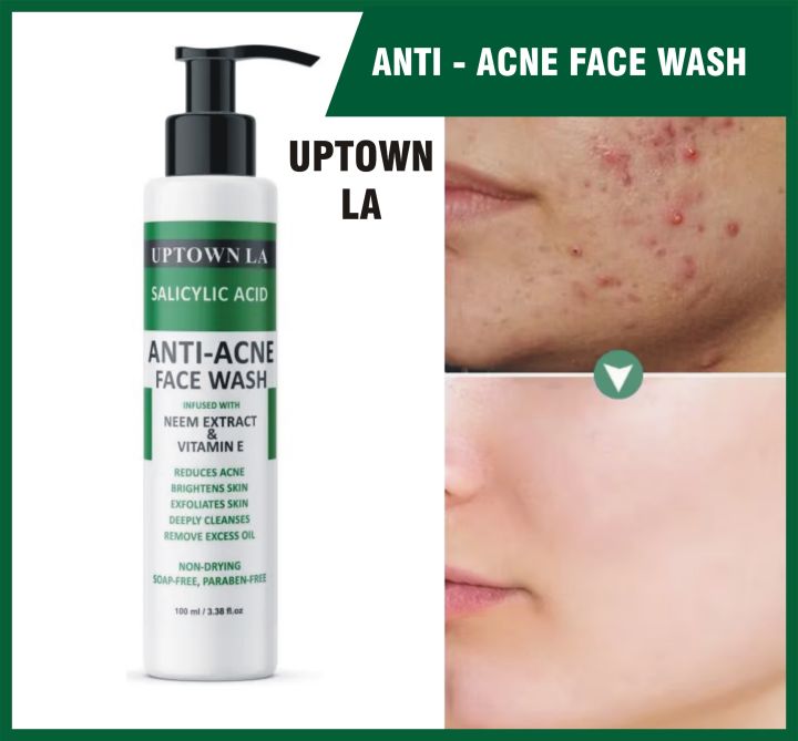UPTOWN LA Anti Acne Face Wash – Prevents Acne Eruptions, Removes Excess Oil, Reduces Blackheads & Whiteheads