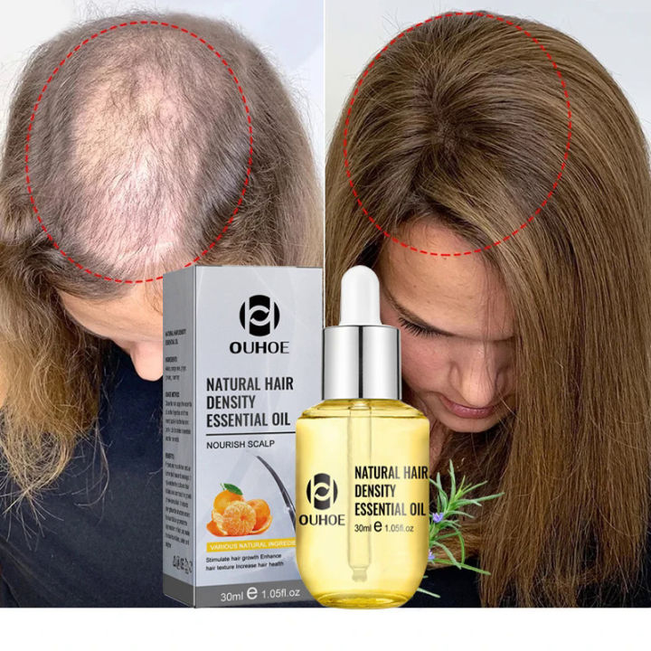 Natural Ginger Hair Growth Products For Men And Women Anti Hair Loss Oil Fast Regrowth Thicken Scalp Hair Growth Serum 30g