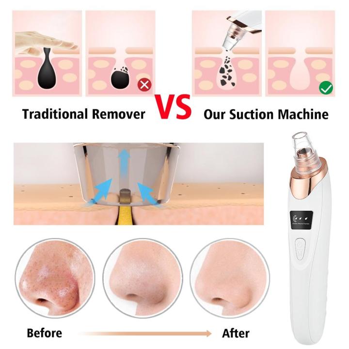 5%20in%201%20Electric%20Blackhead%20Acne%20Oil%20Remover%20Vacuum%20Suction%20Face%20Pore%20Cleaner%20Machine%20-%20Image%207