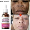 Organic Rosehip Seed Oil For Face-Pure Cold Pressed Facial Oil,Natural Non-Greasy Moisturizing Face Skin Care Serum New. 