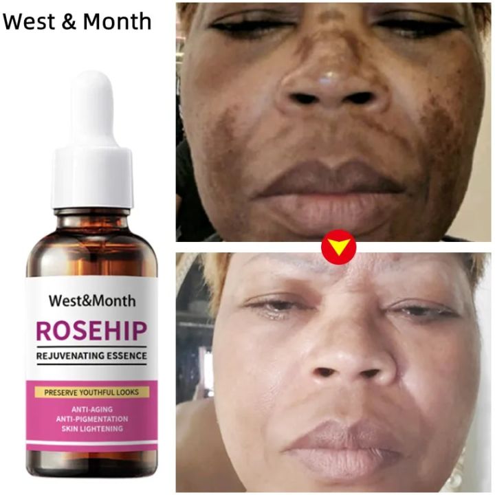 Organic Rosehip Seed Oil For Face-Pure Cold Pressed Facial Oil,Natural Non-Greasy Moisturizing Face Skin Care Serum New