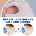Skin Tag eye Wart Mole Remover Pen Woman Skin Care Removing Against Moles Pimple Patch Remove Black Dot. 