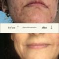 Retin-oil Serum 0.5% | AccuFix Cosmetics Retinol Serum (30ml) | Anti-aging Serum. 
