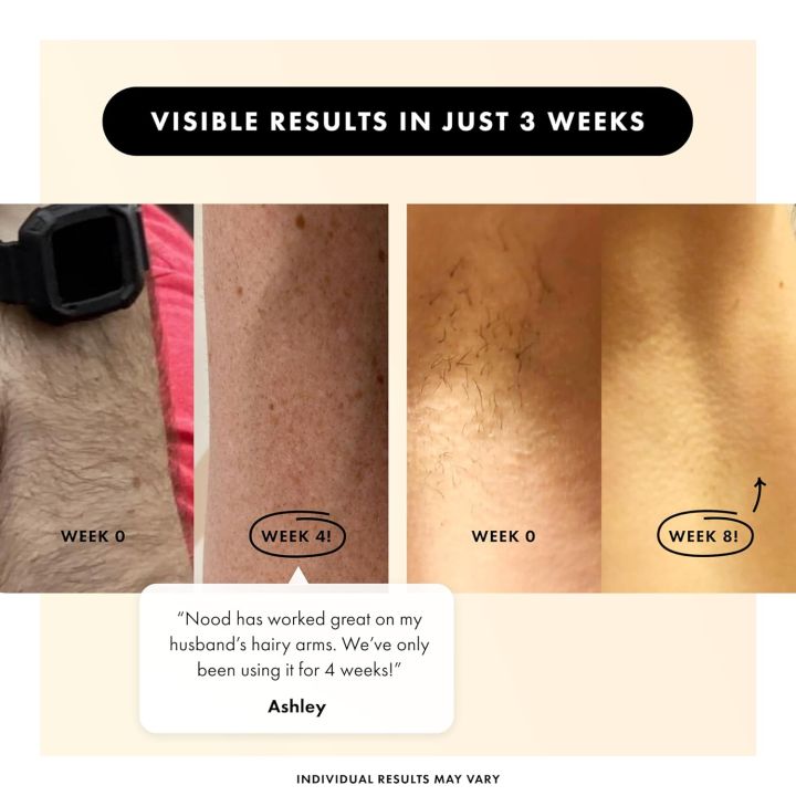 NEW Flasher 2.0 by Nood, IPL Laser Hair Removal Device for Men and Women, Pain-free and Permanent Results, Safe for Whole Body Treatment - Gloss White