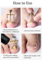 Professional Ingrown Toe Nail Correction Pedicure Toes Treatment Tool for Paronychia, Ingrown Nail Corrector Toenail Foot Nail Care,Eliminate Pain & Remover Orthotic Appliance, Stainless Steel Toes Treatment Manicure Pedicure Tool. 