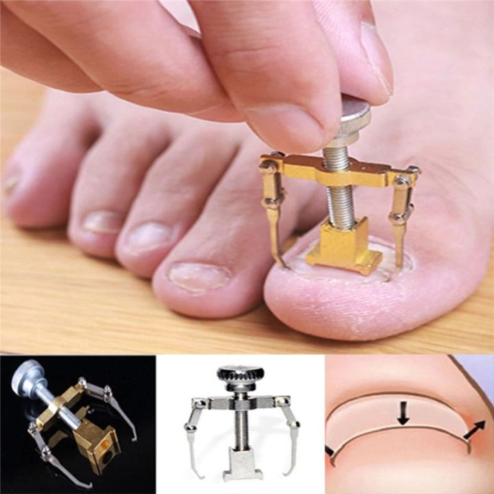 Ingrown Toenails Nail Corrector Foot Toe Nail Straightening Clip Fixer Stainless Steel Medical Clipper Recove Professional Toenails Lifter Feet Acronyx Bunion Repair For Nails Pliers