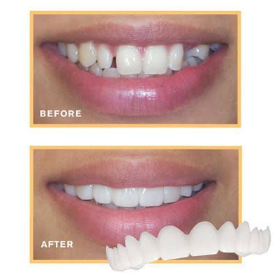 Snap-On%20Teeth%20Veneers%20for%20Upper%20&%20Lower%20%7C%20Comfortable%20Silicone%20Denture%20Covers%20%7C%20Instant%20Smile%20Braces%20-%20Image%202