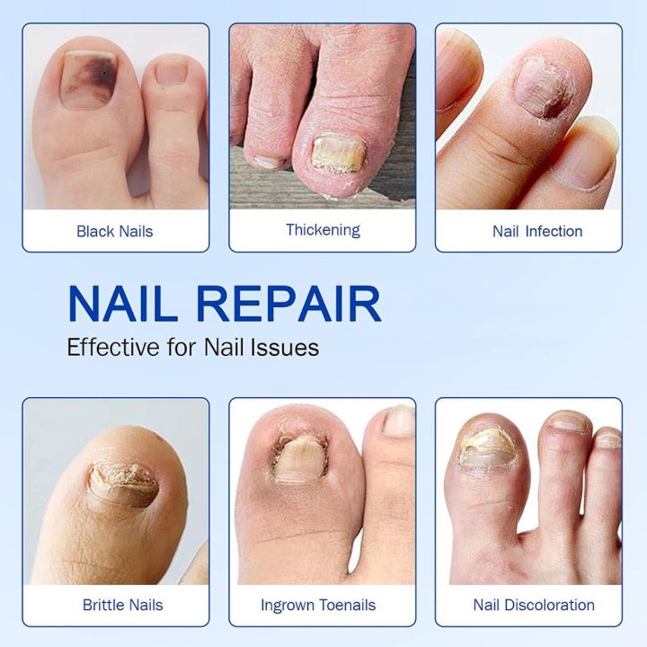 1%20SOLUTION%20SHOP%20Nail%20Fungal%20Treatment%20Patch%20%7C%20Anti%20Fungus%20Toe%20Nail%20Repair%20Strips%20%7C%20Overnight%20Hydrogel%20Patch%20for%20Yellow%20Nails,%20Cracked%20&%20Brittle%20Nail%20Care%20%7C%20Fast%20Nail%20Restoration%20%7C%2021%20Patches%20%7C%20Anti%20Infection%20Nail%20Protector%20for%20Healthy%20Shiny%20Toenails%20-%20Image%205
