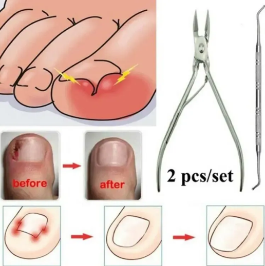 Ingrown Toenails Nail Corrector Foot Toe Nail Straightening Clip Fixer Stainless Steel Medical Clipper Recove Professional Toenails Lifter Feet Acronyx Bunion Repair For Nails Pliers