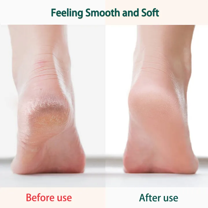10PCS%20Professional%20Pedicure%20Tools%20Set,%20Foot%20files%20Callus%20Remover%20for%20Feet%20Foot%20Care%20Kit%20with%20Nail%20File%20Hard%20Skin%20Remover%20Pedicure%20kit%20for%20Cracked%20Heels%20and%20Dead%20Skin%20Callus%20Shaver%20for%20Men%20Women%20Ideal%20Gift%20-%20Image%206
