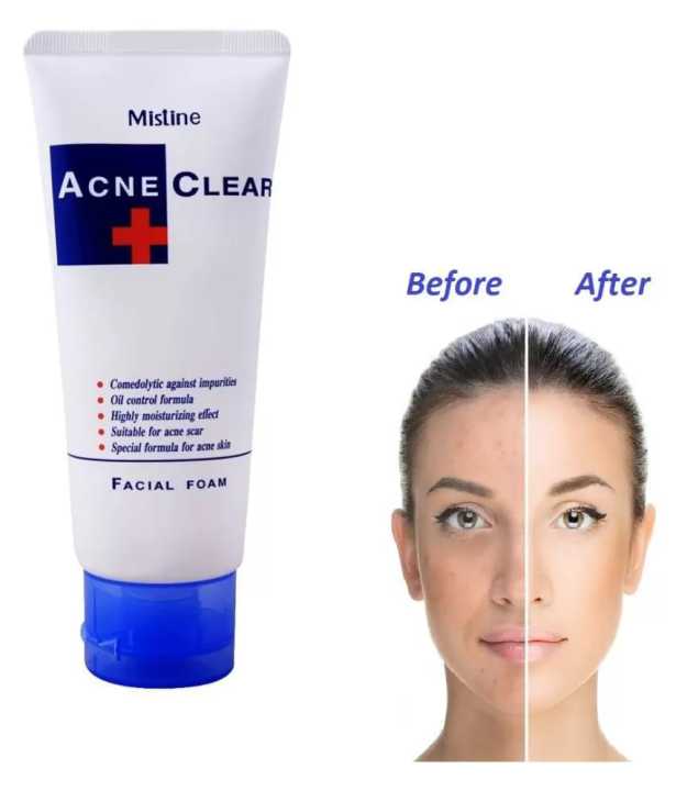 Mistine%20Acne%20Clear%20Facial%20Foam%20Face%20Wash%2085g%20-Thailand%20-%20Image%207