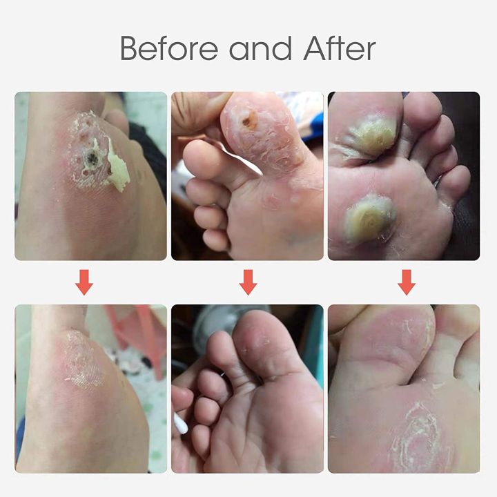 Corn%20Cap%20Remover%20Pads,%20Wart%20Remover%20Pads,%20Toe%20Corn%20and%20Callus%20Removal,%20One%20Step%20Pads,%20Cushioning%20Protection%20Against%20Shoe%20Pressure,%2015Pads%20-%20Image%205