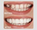 Snap-On Teeth Veneers for Upper & Lower | Comfortable Silicone Denture Covers | Instant Smile Braces. 