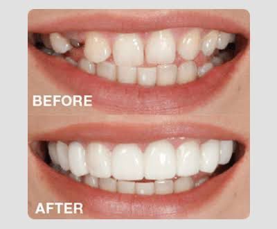 Snap-On%20Teeth%20Veneers%20for%20Upper%20&%20Lower%20%7C%20Comfortable%20Silicone%20Denture%20Covers%20%7C%20Instant%20Smile%20Braces%20-%20Image%208