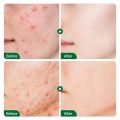 Anti Acne Treatment Scar Removal Cream. 