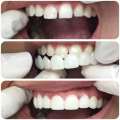 Perfect Fit Snap-On Smile Veneers – Upper & Lower Natural Look Teeth Covers & Braces. 