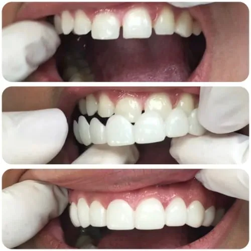 Perfect%20Fit%20Snap-On%20Smile%20Veneers%20%E2%80%93%20Upper%20&%20Lower%20Natural%20Look%20Teeth%20Covers%20&%20Braces%20-%20Image%203