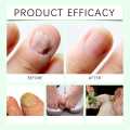7 Days Ginger Nail Growth Serum – Nail Strengthening and Nourishing Serum for Healthy, Shiny and Strong Nails. 