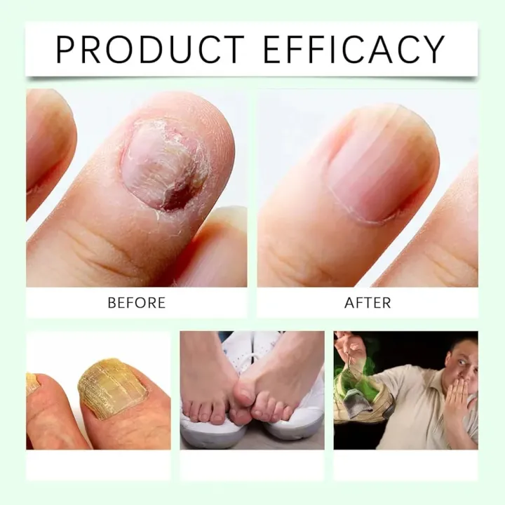 7%20Days%20Ginger%20Nail%20Growth%20Serum%20%E2%80%93%20Nail%20Strengthening%20and%20Nourishing%20Serum%20for%20Healthy,%20Shiny%20and%20Strong%20Nails%20-%20Image%202