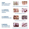 32Pcs Nail Treatment Patch Anti Fungal Nail Correction Stickers Ingrown Toenail Care Paronychia Anti Infection Repair Patch Yao Store. 
