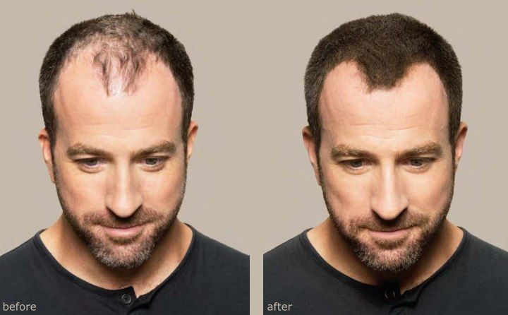 35g%20King%20Hair%20Fibers%20Refill%20(Light%20Brown)%20Best%20alternative%20toppik,%20Caboki,%20Hair%20Fibers%20Refill%20Pack,%20King%20Hair%20Fibers%20100%25%20Natural%20Hair%20Fibers%20Instantly%20Thickens%20Thinning%20or%20Balding%20Hair%20for%20Men%20and%20Women%20-%20Completely%20Conceals%20Hair%20Loss%20in%2015%20Seconds%20-%20Image%203