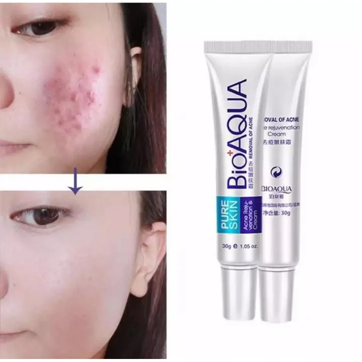 Bioaqua%20-%20Bio%20Aqua%20Acne%20Scar%20Mark%20Removal%20Treatment%20Cream%2030g%20-%20Image%202