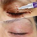 Warts Removal Pen Eliminate Wart Pen Wart Liquid Hand Foot Warts Remove Filiform Warts Flat Warts Condyloma Acuminatum. 