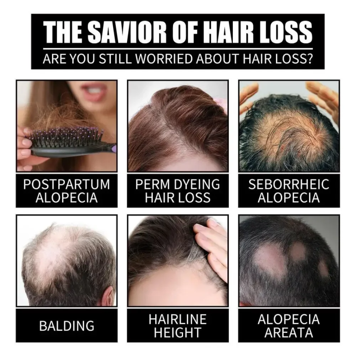 FORT%20%20Minoxidil%20Hair%20Growth%20Spray%20-%20Hair%20Tonic%20for%20Hair%20Care%20and%20Hair%20Growth%20-%20Premium%20Hair%20Care%20ProductWomen%20and%20Men%20all%20Hair%20Types%20-%20Image%203