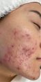 Bio aqua Acne Cream Face Skin Care Acne Anti-Wrinkle Removal Cream Spots Scar Blemish Marks 30g. 