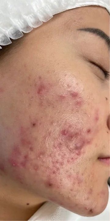 Bio%20aqua%20Acne%20Cream%20Face%20Skin%20Care%20Acne%20Anti-Wrinkle%20Removal%20Cream%20Spots%20Scar%20Blemish%20Marks%2030g%20-%20Image%206