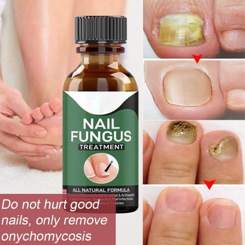 Fast Nail Fungal Treatments Nail Repair Essences Serum Care Treatments Foot Nail Fungus Removal Gel Paronychia Onychomycosis