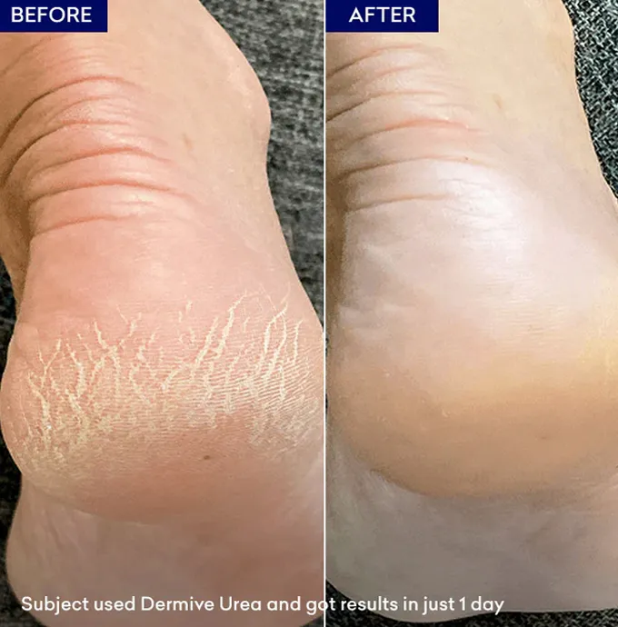 Jenpharm%20-%20PACK%20OF%202%20Dermive%20Urea%20Economy%20Pack%20350ml%20%7C%2010%25%20Moisturizing%20Cream%20%7C%20For%20Eczema,%20Psoriasis,%20Cracked%20Heels%20&%20Dry%20Sensitive%20Skin%20-%20Image%205