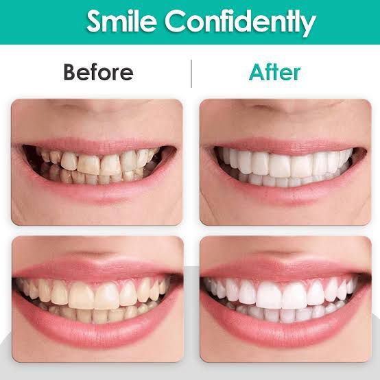 Snap-On%20Teeth%20Veneers%20for%20Upper%20&%20Lower%20%7C%20Comfortable%20Silicone%20Denture%20Covers%20%7C%20Instant%20Smile%20Braces%20-%20Image%207