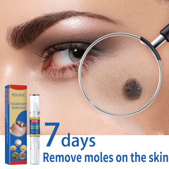 Skin%20Tag%20Wart%20Mole%20Remover%20Pen%20-%20Image%202