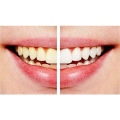 ProWhite Teeth Whitening Kit: Advanced Formula for Brighter Smiles UltraBright Teeth Whitening Strips: Professional Grade Whitening at Home SmileMaxx LED Teeth Whitening System: Fast Results, Easy to Use. 