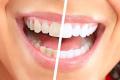 Luma Smile Teeth Whitening Polisher | Professional Stain Removal | Enamel Safe | Whitening Pen & Polish Kit | Fresh Breath | Fast Results. 