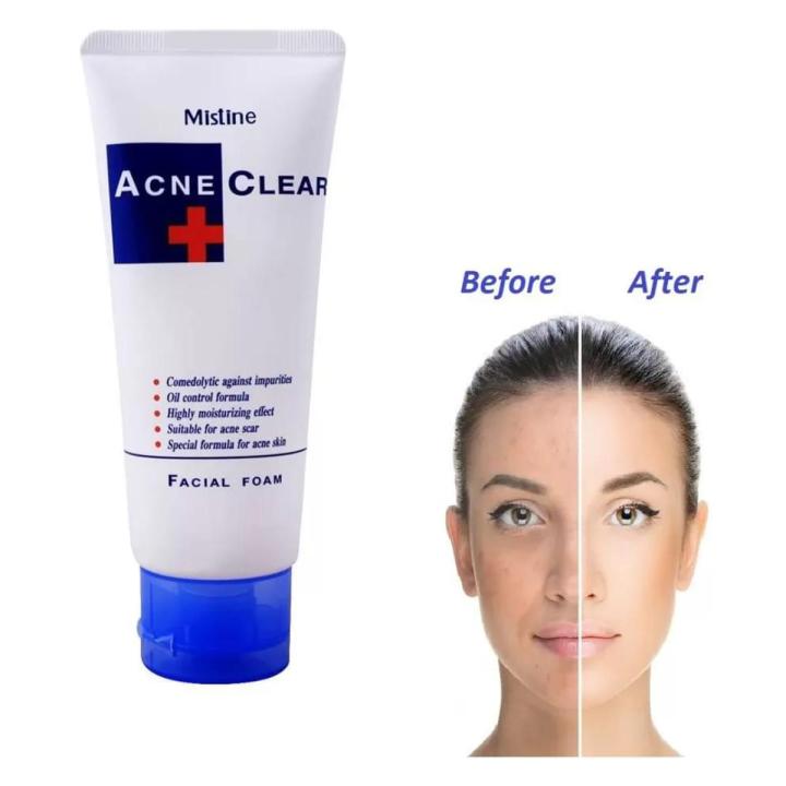 Mistine Acne Clear Facial Foam Face Wash 85g -Thailand