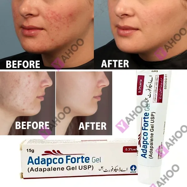 ADAPCO FORTE GEL (Adapalene 0.3% w/w) Best Acne Treatment Gel ...