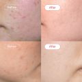 Salicylic Acid Cleanser (100ml) | AccuFix Cosmetics | Salicylic Acid Face Wash. 