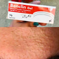 Benclin Gel for Acne - Black head remover cream - Acne scars remover cream. 