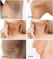 Chanchi Skin Lightening Cream for Dark Underarms, Knees, Elbows, and Bikini Area (30ml). 